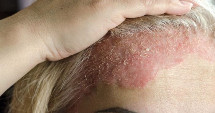 Ekzém, také známý jako dermatitida, je zánětlivé onemocnění kůže. Nejčastěji se projevuje svěděním, zarudnutím a vyrážkou.