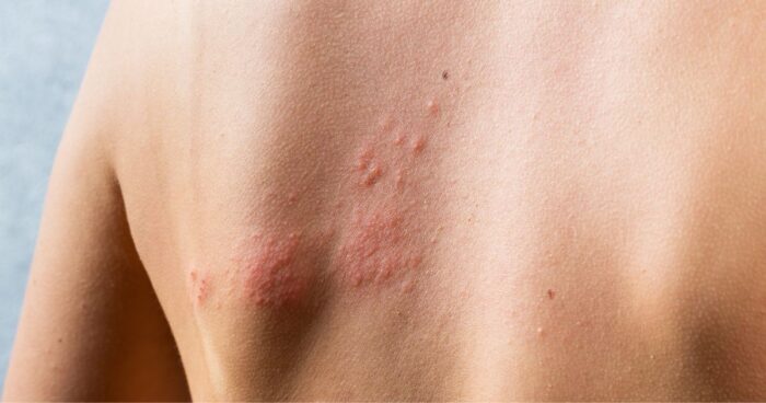 Atopický ekzém neboli atopická dermatitida je chronické zánětlivé onemocnění kůže, které doprovází několik symptomů. Ty vám napoví, jak poznat atopický ekzém.