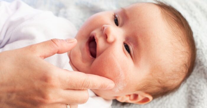 V tom, jak poznat atopický ekzém u dětí, vám nejvíce pomůže místo výskytu. Kojence trápí svědivá vyrážka a puchýřky na tvářích. Děti ve věku 3 až 9 let mívají ekzém v oblasti rukou včetně loketních jamek, nohou, pod koleny, na obličeji i krku.