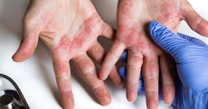 Hlavním ukazatelem v tom, jak poznat atopický ekzém, jsou příznaky onemocnění, mezi něž patří svědění, zarudnutí kůže, suchá až šupinatá kůže, vyrážka a odlupující se plochy kůže.