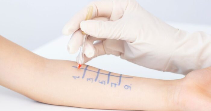 Pokud máte podezření, že vám některý z alergenů způsobuje problémy, můžete si udělat domácí test na alergie. V případě potvrzení alergie je nutné vyhledat pomoc alergologa. Provádí se buď kožní, nebo krevní testy, které pomáhají s přesným určením diagnózy, od níž se odvíjí správná léčba.