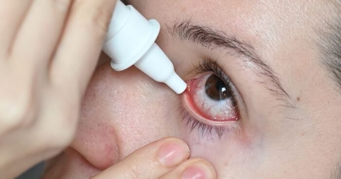 Léčba alergického zánětu spojivek zahrnuje oční kapky a prevenci.
