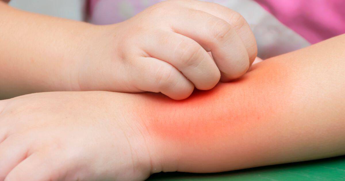 Příznaky alergie na slunce u dětí se projevují několik minut někdy i hodin po pobytu na sluníčku. Hlavním příznakem této alergie je sluneční vyrážka.