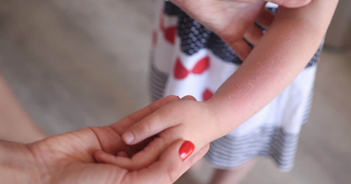 Atopický ekzém u dětí je chronické zánětlivé onemocnění kůže. Za jeho rozvojem může stát několik příčin. 